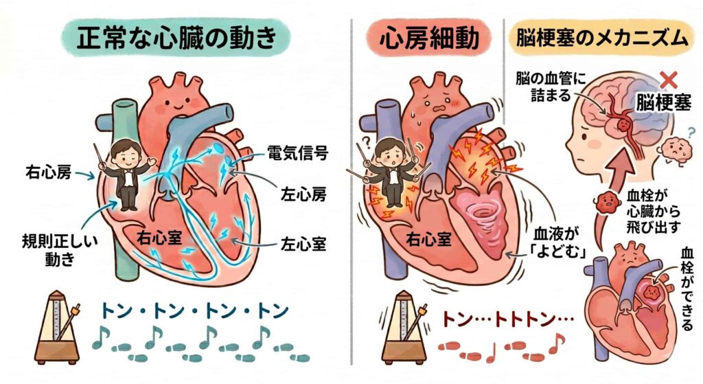 心房細動による脳梗塞のメカニズム図。心臓内で血液がよどんで血栓ができ、その血栓が脳の血管に詰まる流れを示している。