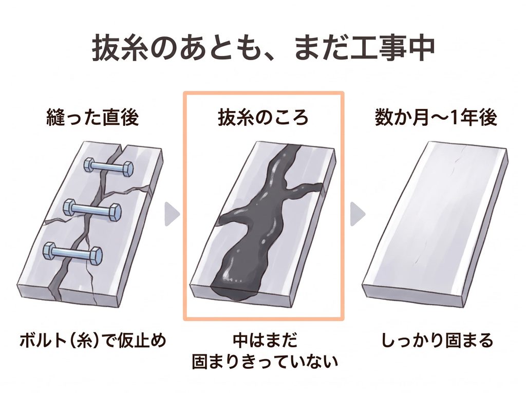 傷が治っていく流れを道路の工事にたとえた3コマのイラスト。①縫った直後：ひび割れた道路をボルト（糸）で仮止め、②抜糸のころ：中はまだ固まりきっていない、③数か月〜1年後：しっかり固まる。